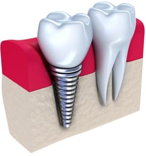 zubni implant - procedura postavljanja zubnog implanta