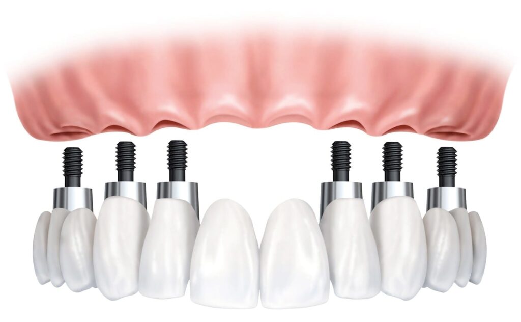 zubni implanti procedura - zubni implanti - ortopan snimak pre ugradnje implanta
