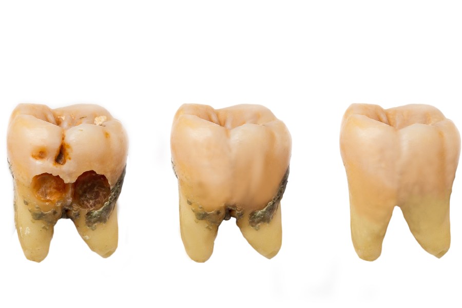 3 oštećena zuba na beloj pozadini