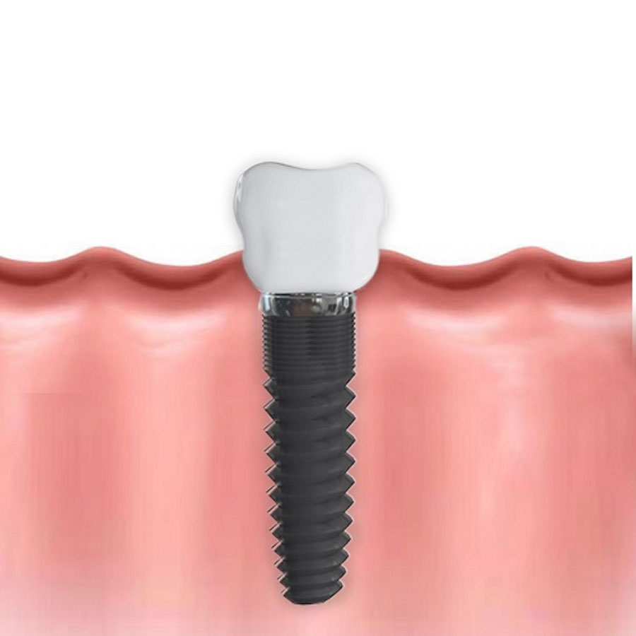 zubni implant - zubni implantat