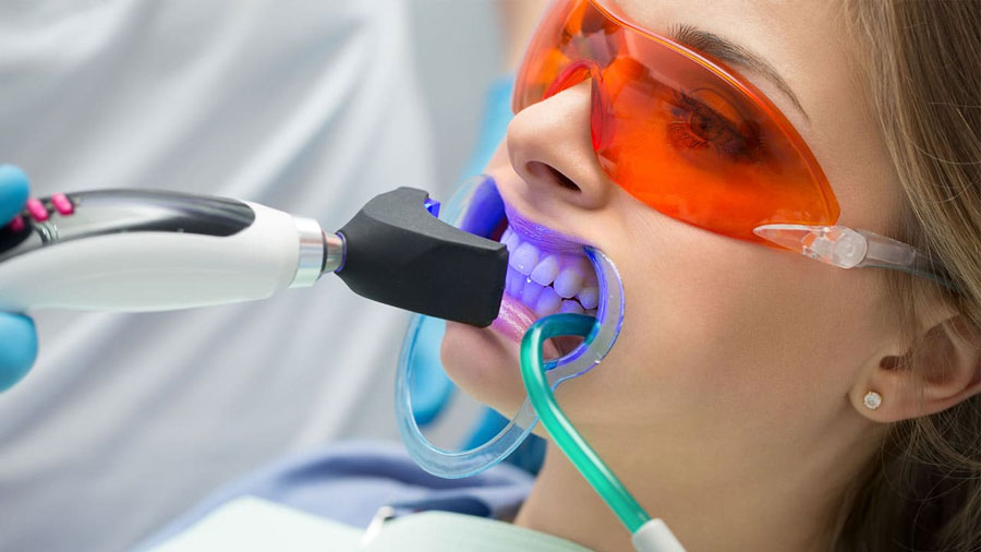 tretman laserskog izbeljivanja zuba - lasersko izbeljivanje zuba kod stomatologa - lasersko izbeljivanje zuba - izbeljivanje zuba laserom - beljenje zuba laserom