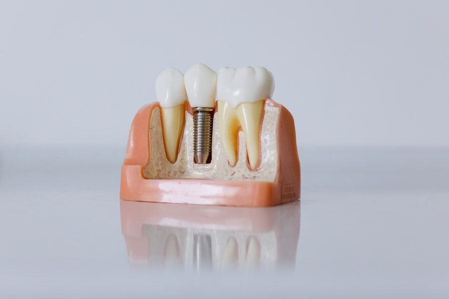 zubni implanti kao model 