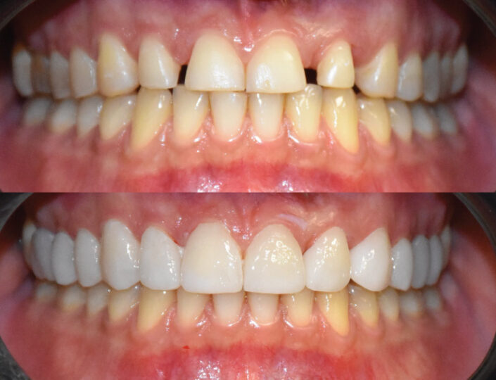 osmeh pre i posle postavljanja vinira - izgled zuba pre i posle postavljanja faseta