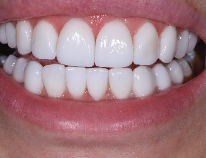 prikaz zuba nakon uspešne estetske intervencije