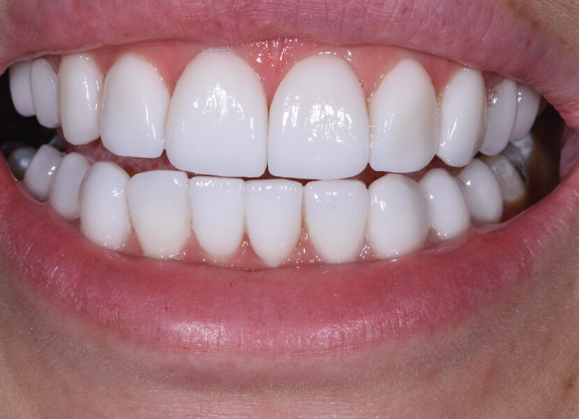 prikaz zuba nakon uspešne estetske intervencije