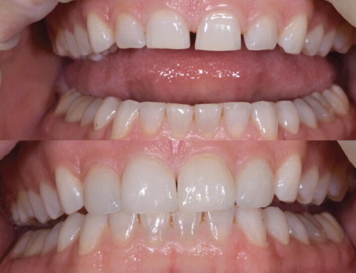 zubi pre i posle estetskog tretmana