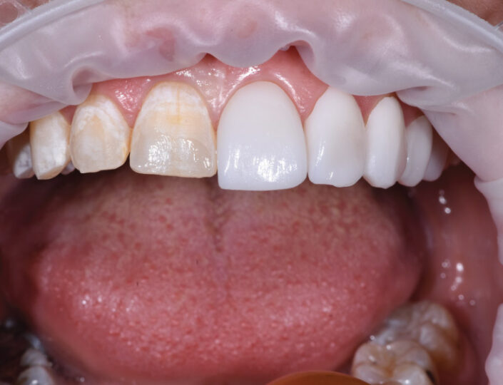 postavljanje vinira u procesu - polovično postavljeni viniri za zube