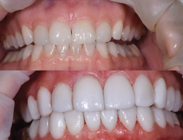 viniri za zube pre i posle postavljanja - fasete za zube pre i posle postavljanja