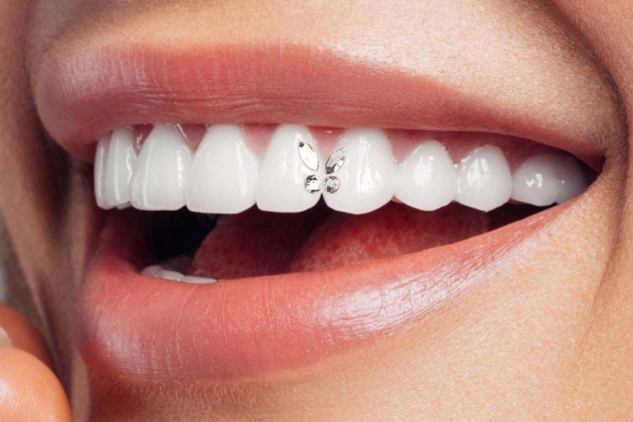prelepi blistavi osmeh sa cirkonom u obliku leptira na zubima