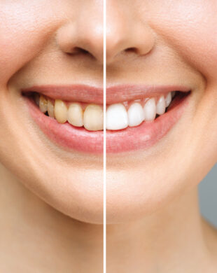 izbeljivanje zuba pre i posle tretmana