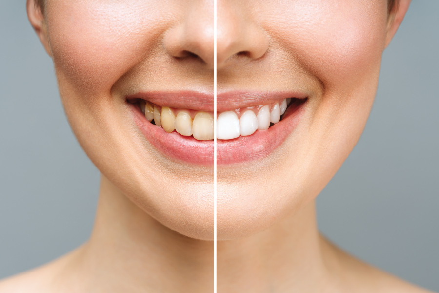 izbeljivanje zuba pre i posle tretmana