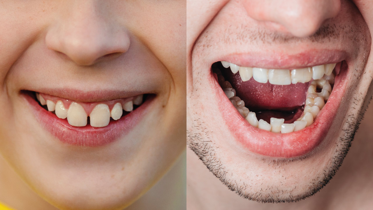 krivi zubi kod dece i odraslih prikazani paralelno